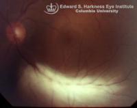 Myelinated of the inferior arcuate nerve fiber bundles